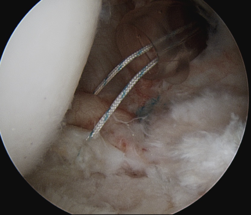 Posterior Labral Tear 3